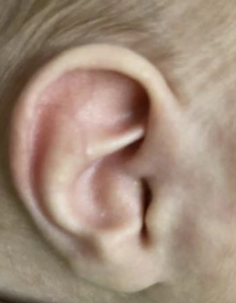 Example of a newborn ear with a conchal crus deformity