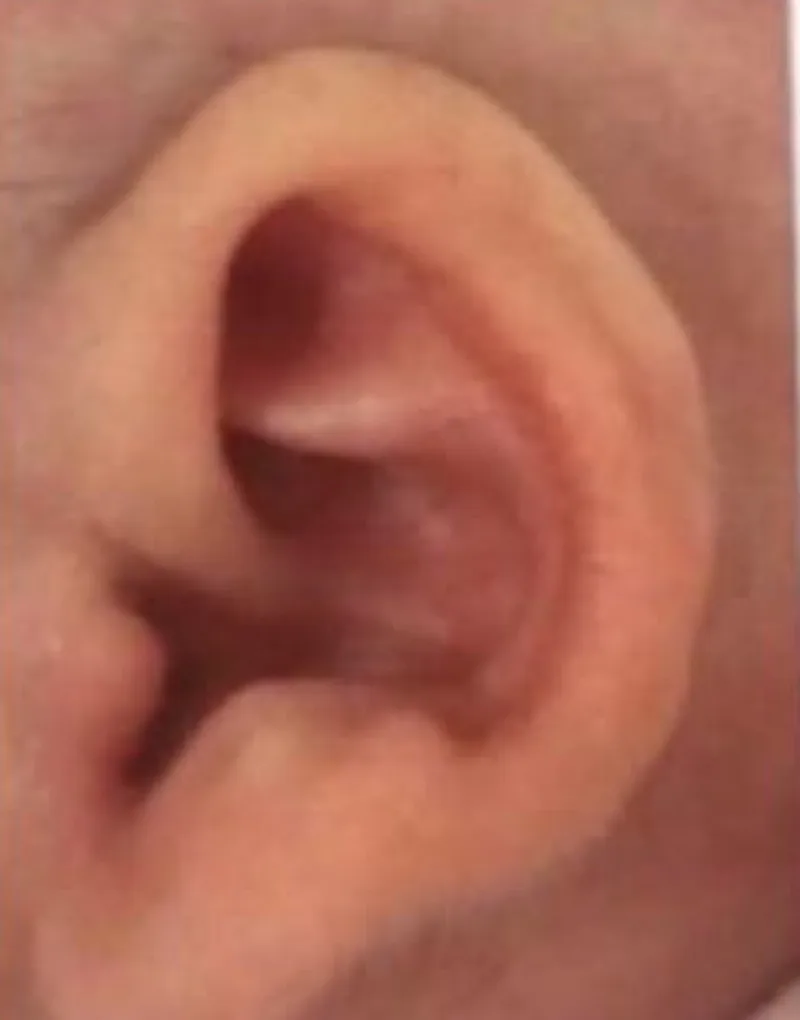 Example of a newborn ear with a constricted rim
