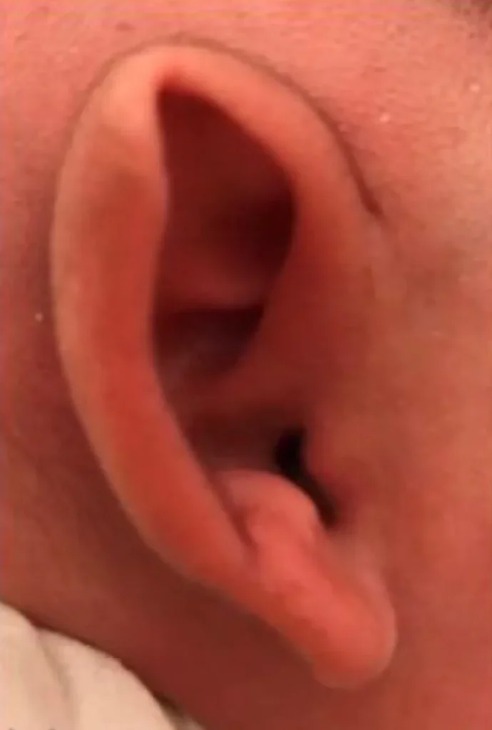 Example of a newborn ear with the upper rim rolled inward