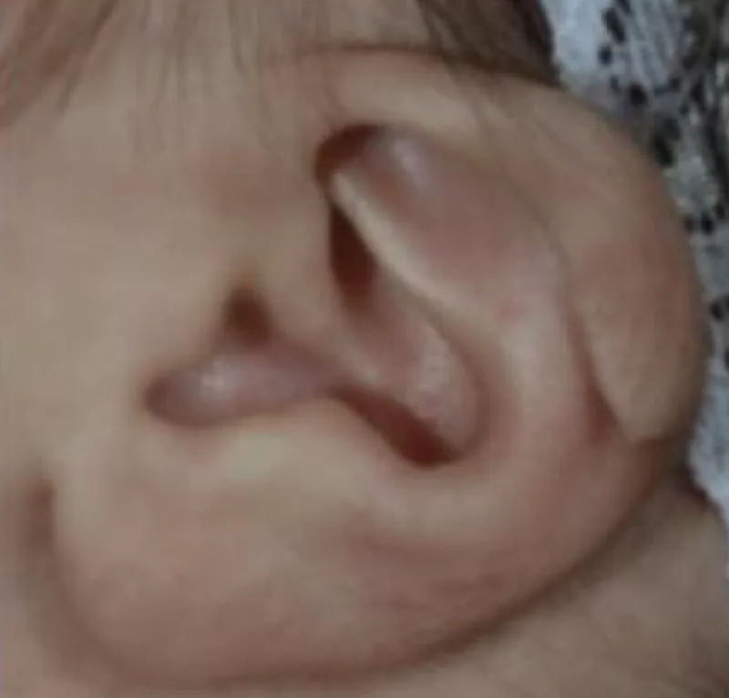 Example of a newborn ear with the upper rim folded down