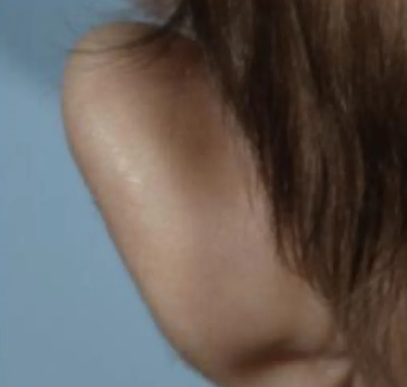 Example of a prominent ear seen from behind, projecting away from the head