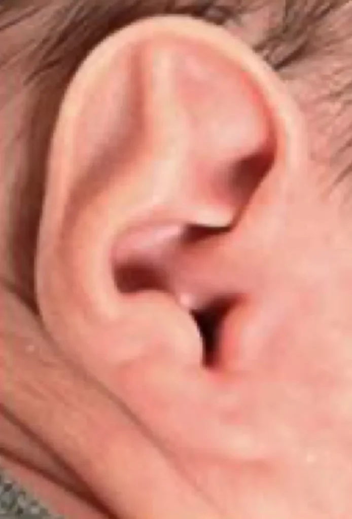 Example of a newborn ear with Stahl's deformity