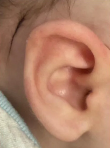 Example A after molding: ear with a smooth, rounded rim