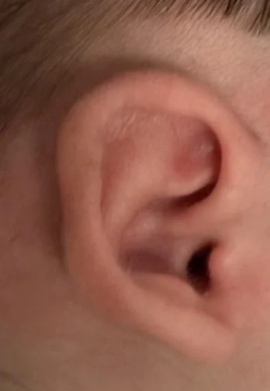 Example A before molding: newborn ear with a folded upper rim