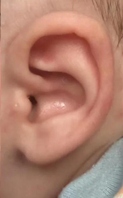 Example B after molding: ear with a natural contour