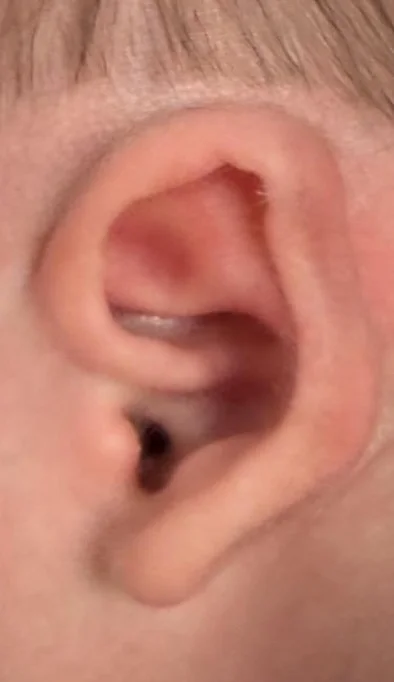 Example B before molding: newborn ear with an irregular fold