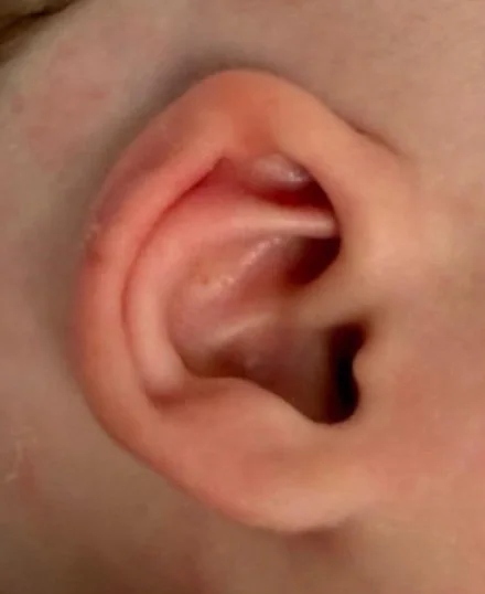 Example C after molding: ear with a wider, open rim