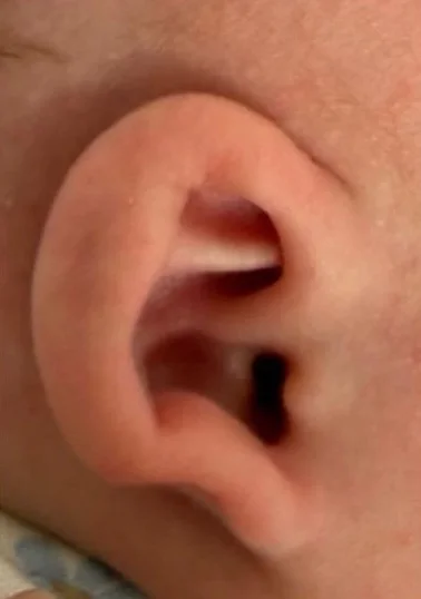 Example C before molding: constricted newborn ear
