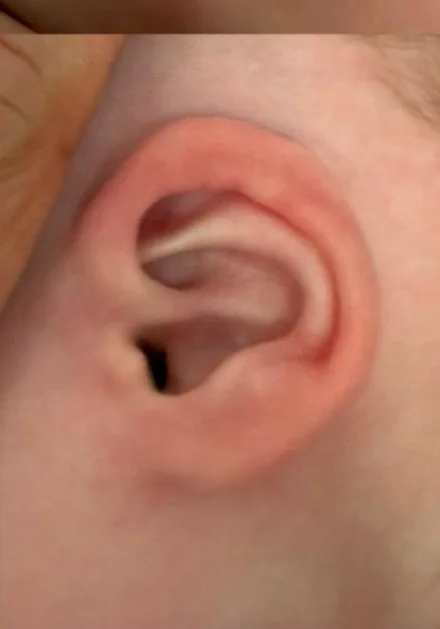 Example D after molding: ear with a more open upper rim