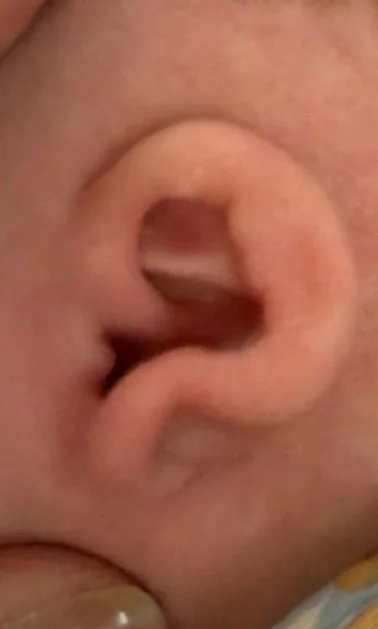 Example D before molding: constricted newborn ear